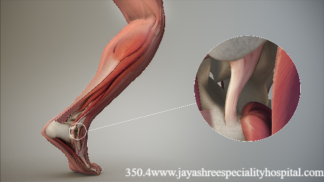Perbedaan Tendon serta Ligamen yang Harus di Pahami